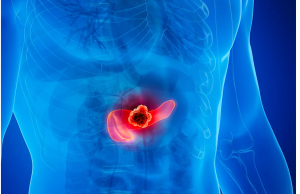 Insulin Resistance Is a Silent Driver of Pancreatic Cancer: Study